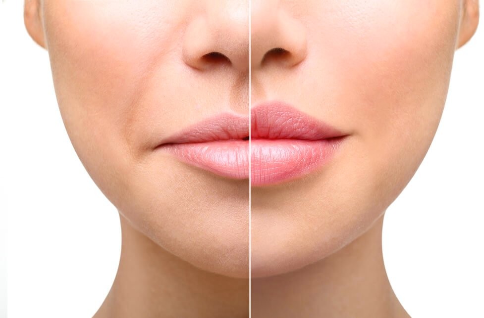 Lip Fillers The Recovery Process Explained Mech Nex